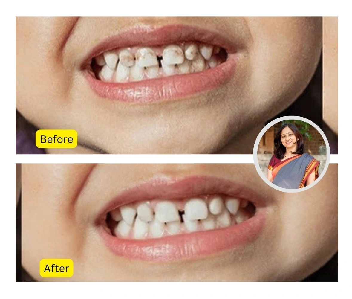 Early Teeth Care